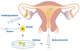 Intracytoplasmic Sperm Injection (ICSI)